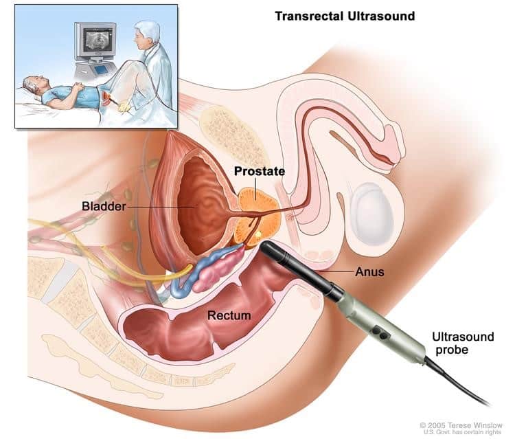 prostata problemi)